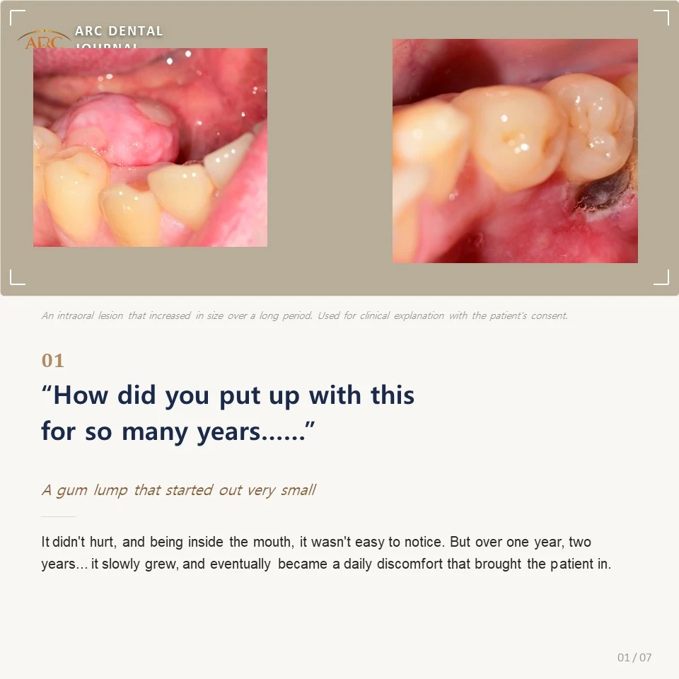 A gum lump that started small and grew over years