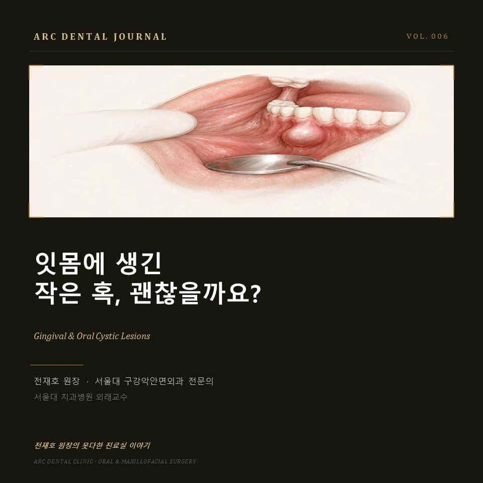 잇몸에 생긴 작은 혹, 괜찮을까요?