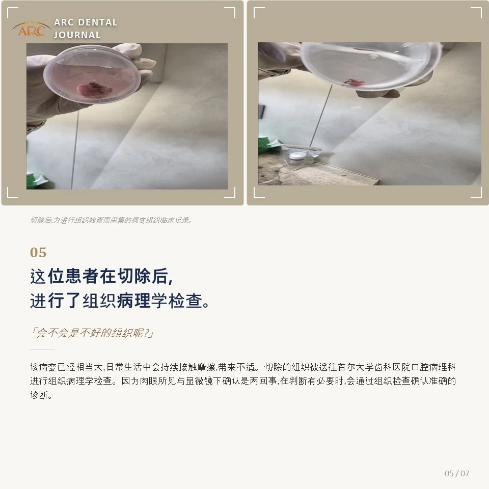 切除后为进行组织活检而采集的病变组织