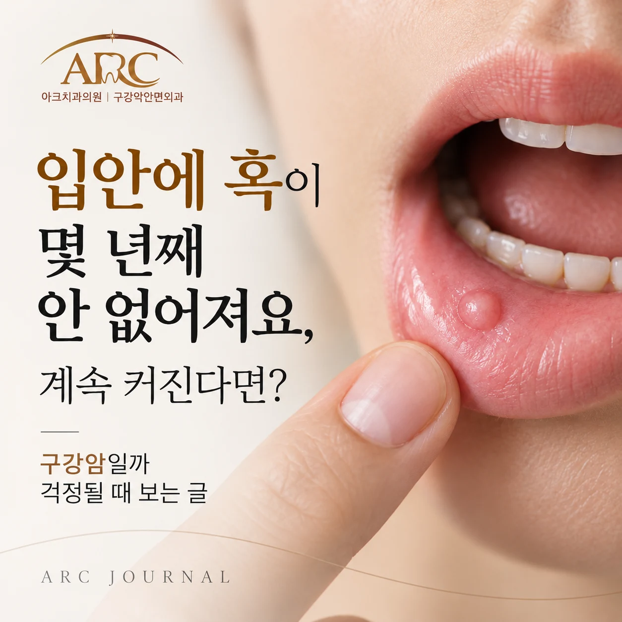 입안에 혹이 몇 년째 안 없어져요. 계속 커지고 있다면?