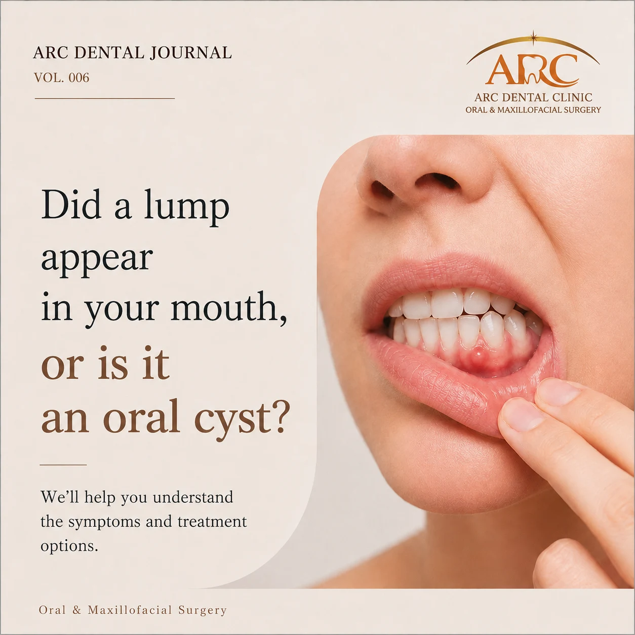 I Have a Bump on My Gums — Is It a Gingival Cyst? Symptoms and Treatment from an Oral & Maxillofacial Surgeon