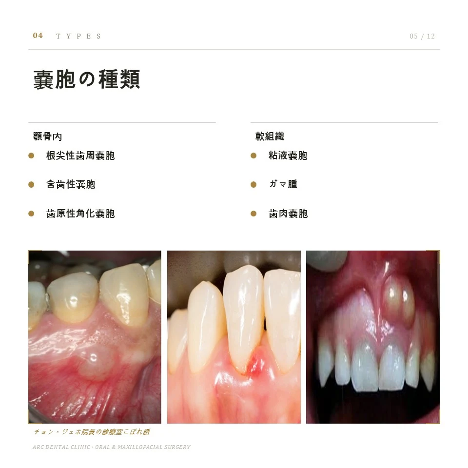 嚢胞の種類