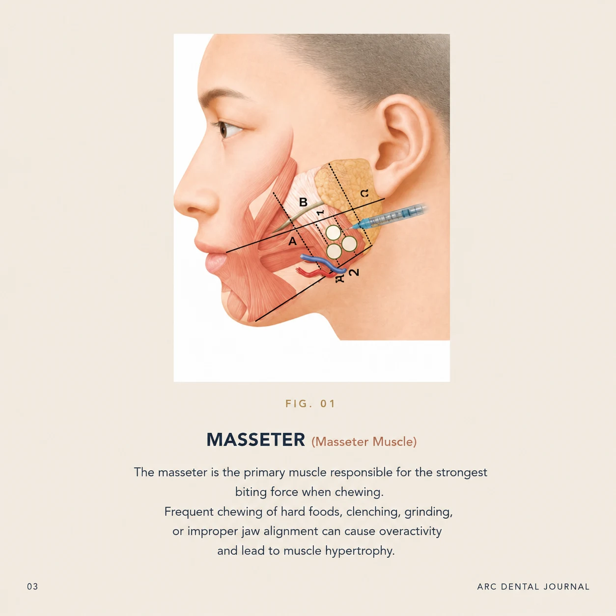 Masseter Muscle Anatomy - FIG. 01 - The primary muscle responsible for the strongest biting force when chewing