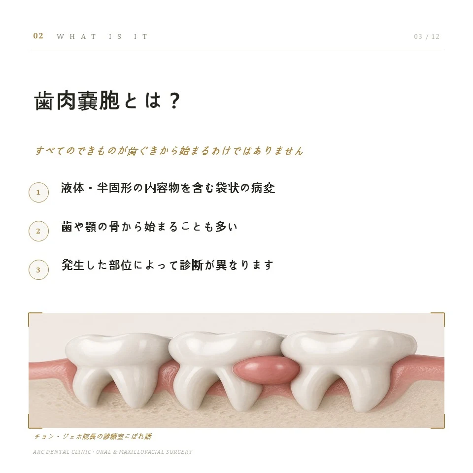 歯肉嚢胞とは?