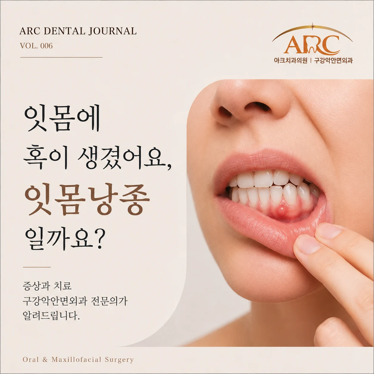 잇몸에 혹이 생겼어요, 잇몸낭종일까요? 증상과 치료 구강악안면외과 전문의가 알려드립니다