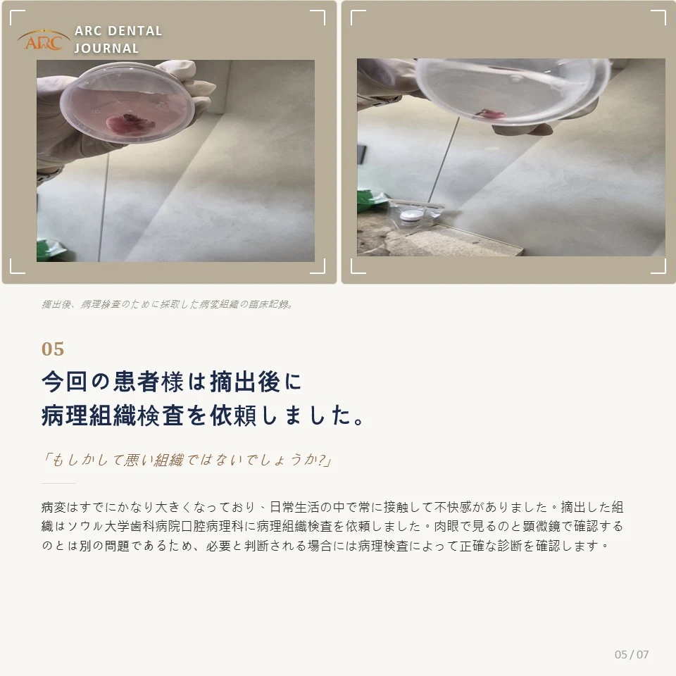 摘出した病変組織の病理組織検査