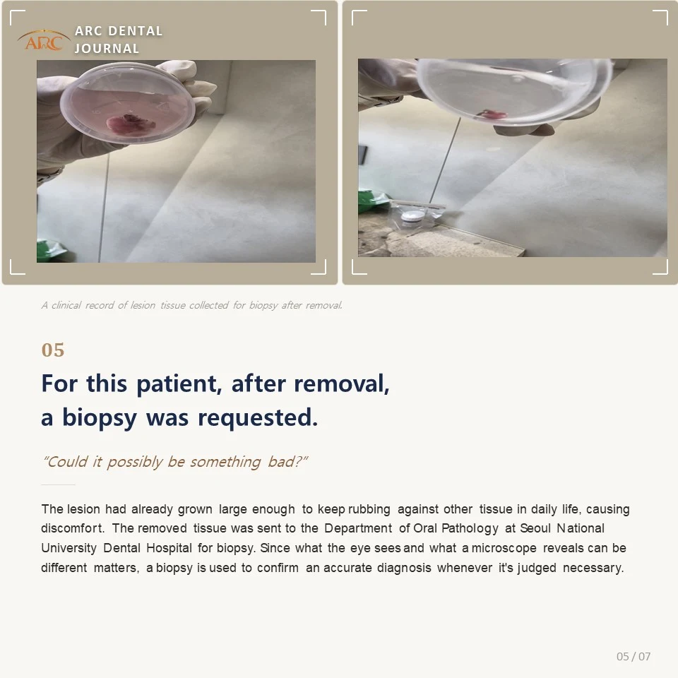 Removed lesion tissue sent for biopsy