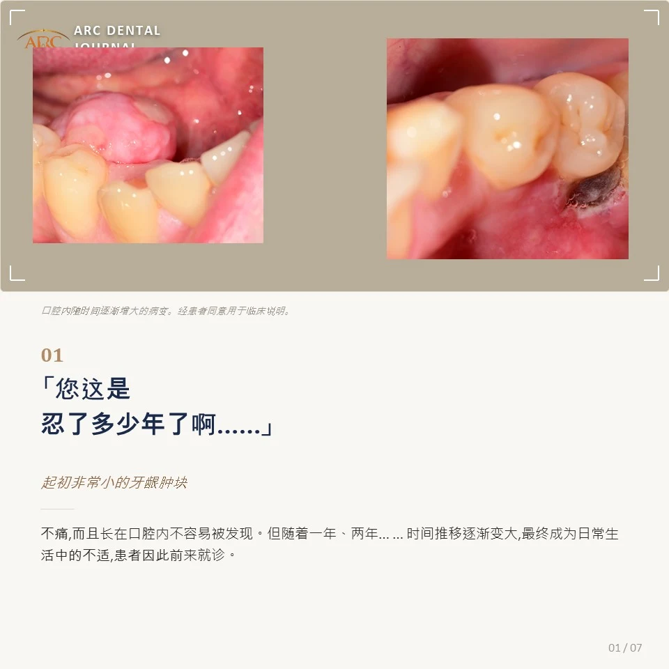 随着时间逐渐增大的口腔内病变临床照片