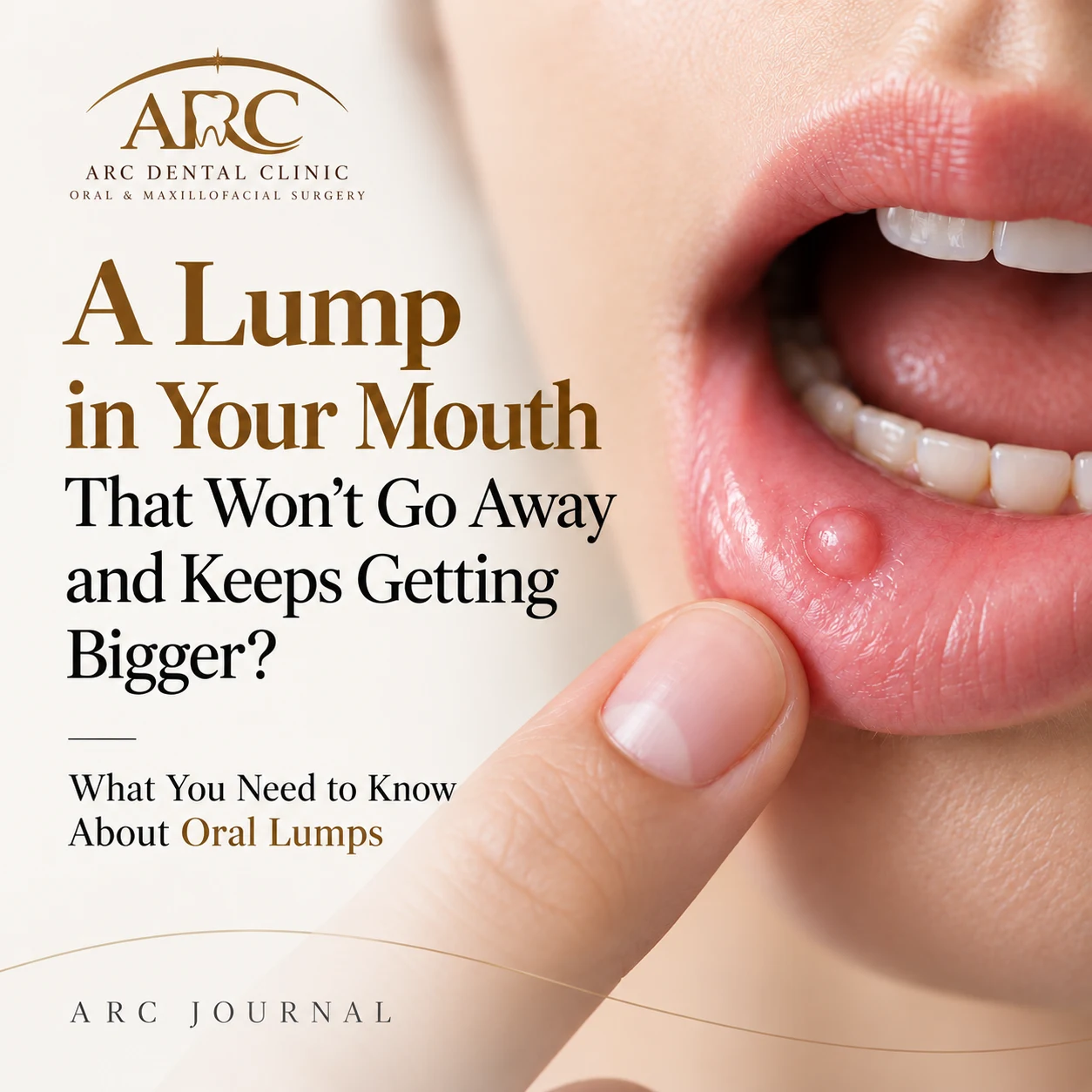 A Mouth Lump That Won't Go Away for Years — Is It Oral Cancer? | Oral & Maxillofacial Surgeon | ARC Dental Clinic