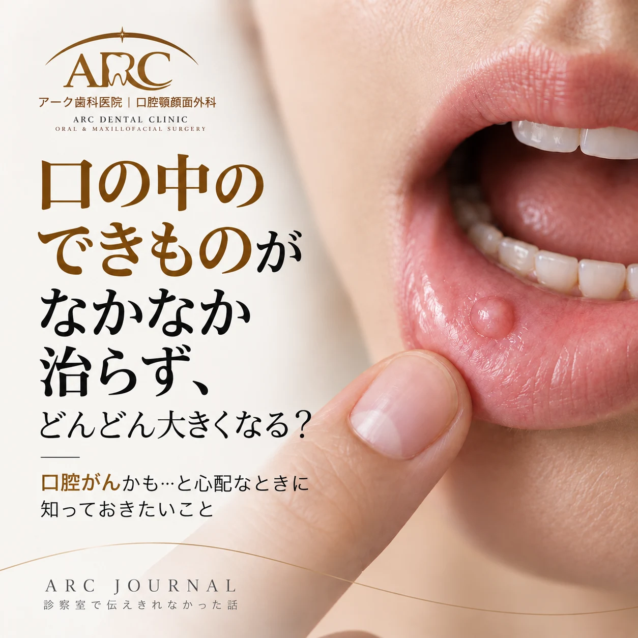 口の中のできものが何年も消えない・大きくなり続ける|口腔がん?口腔顎顔面外科専門医が解説 | ARC歯科医院