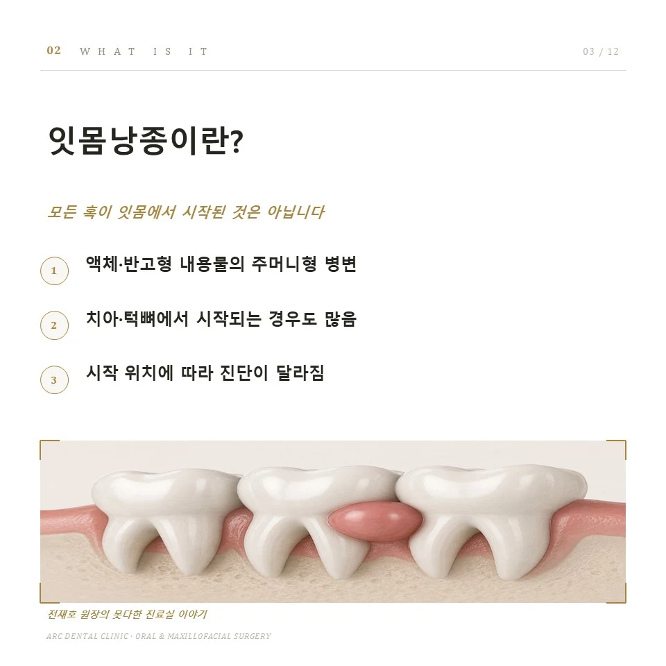 잇몸낭종이란?