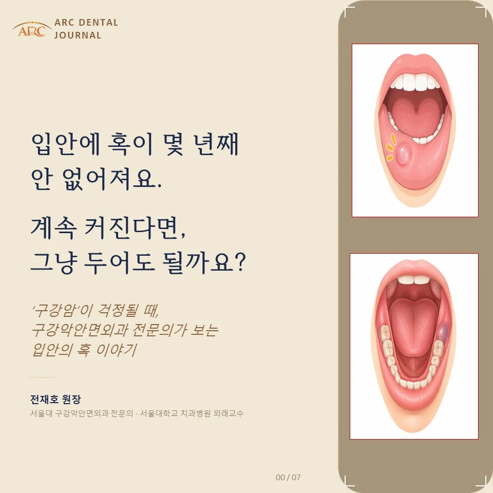 입안에 혹이 몇 년째 안 없어져요. 계속 커진다면, 그냥 두어도 될까요?