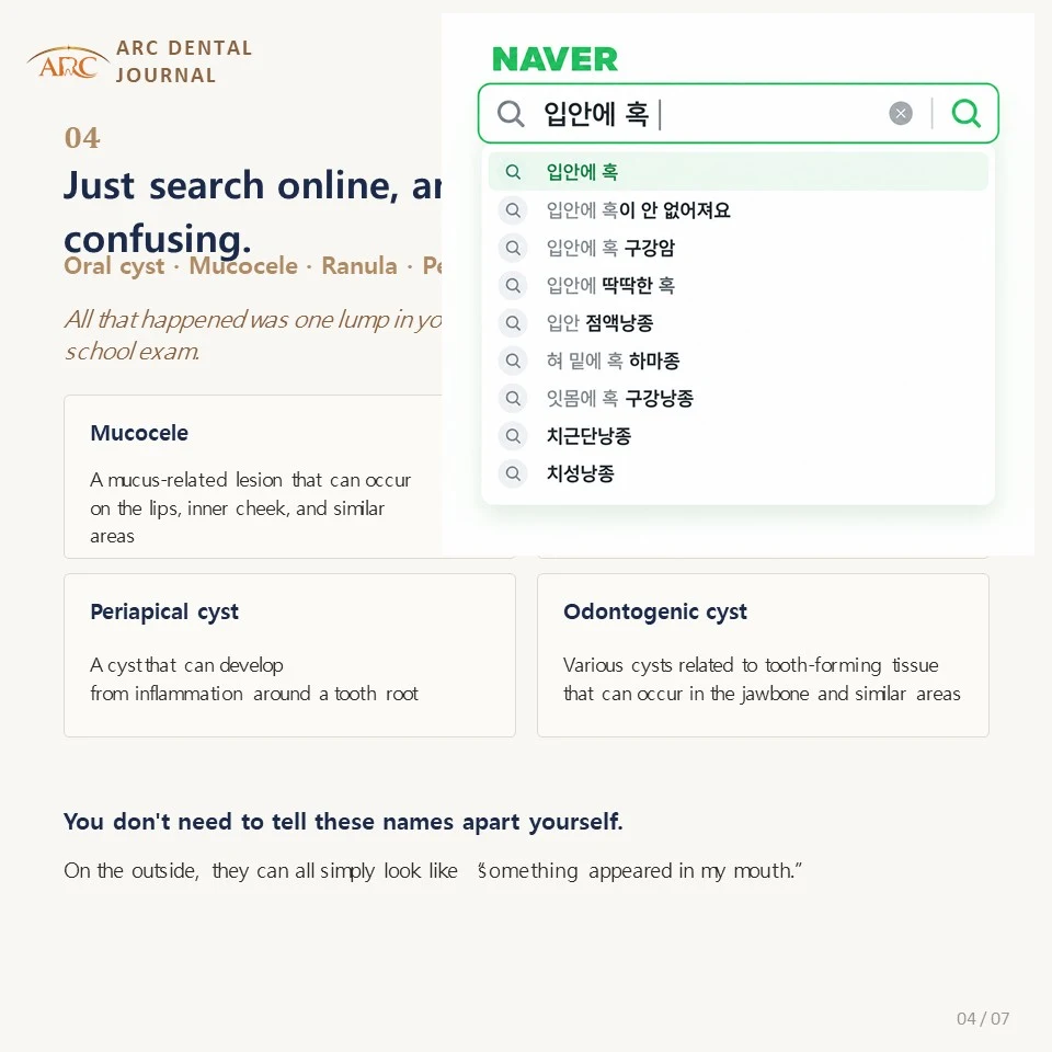 Searching online brings up many confusing names for oral cysts