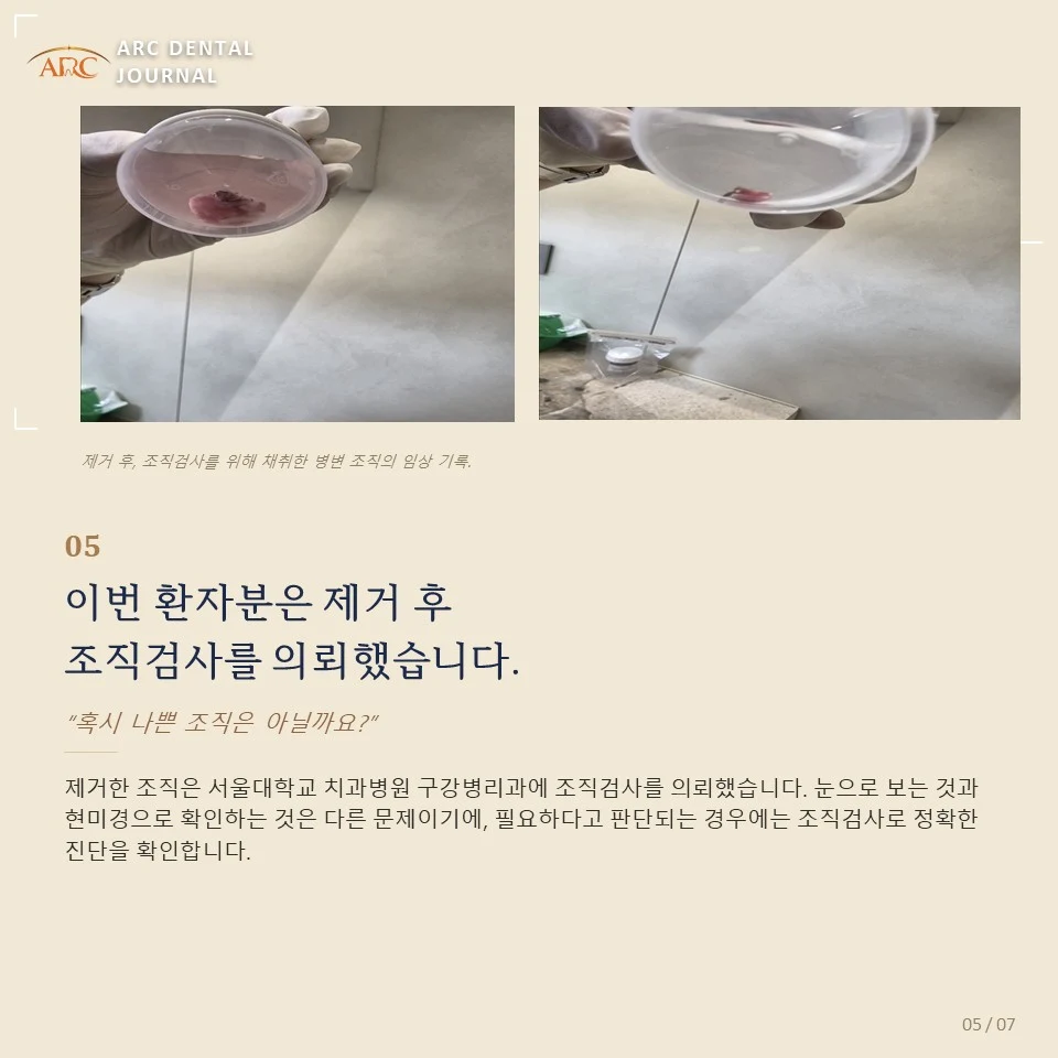 이번 환자는 제거 후 조직검사를 의뢰했습니다 — 서울대학교 치과병원 구강병리과 조직검사