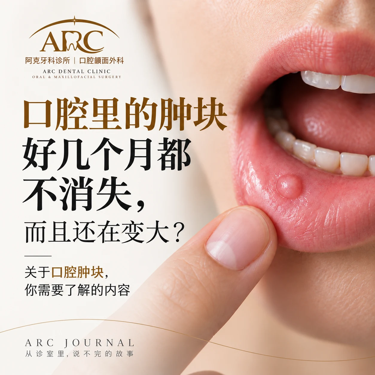 口腔内的肿块好几年不消、还在变大|是口腔癌吗?口腔颌面外科专家讲解 | ARC牙科诊所