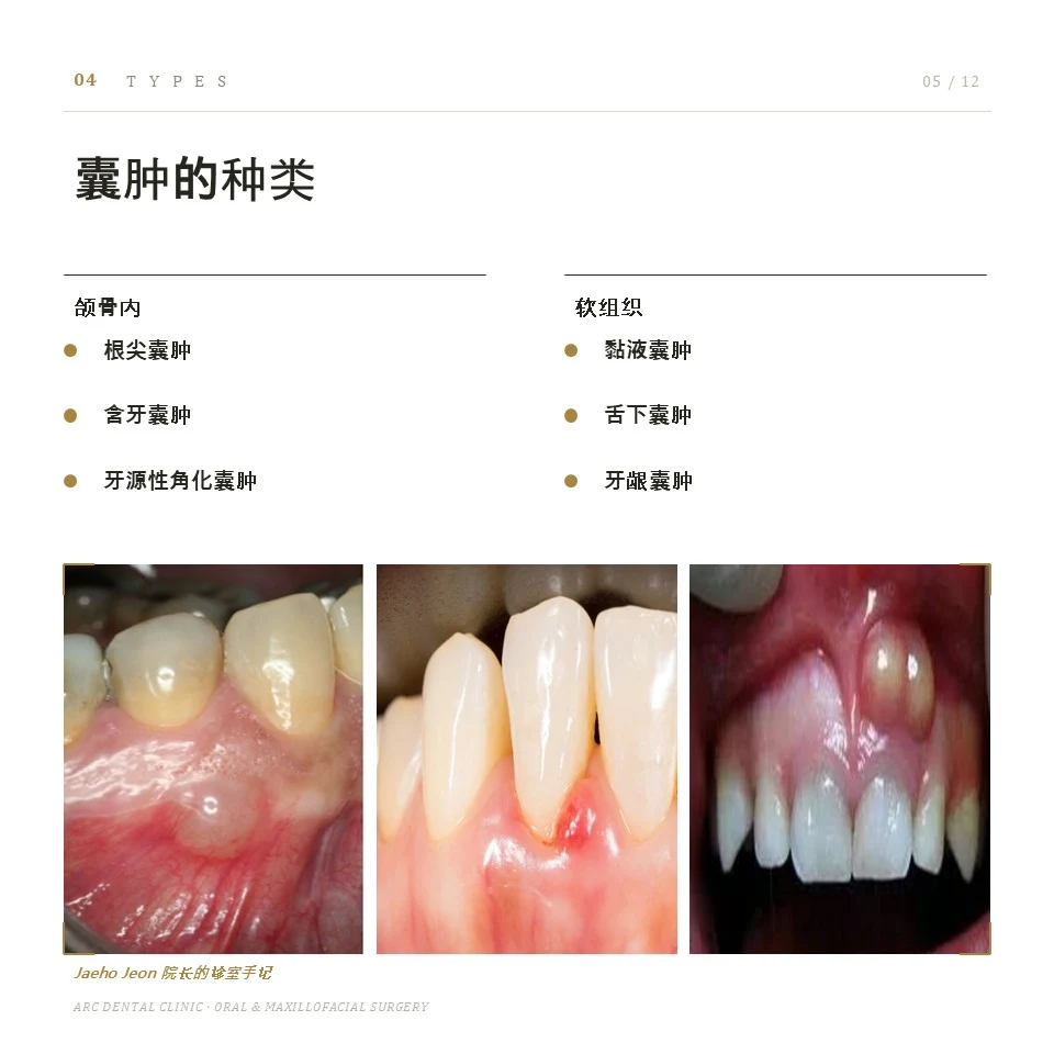 囊肿的种类