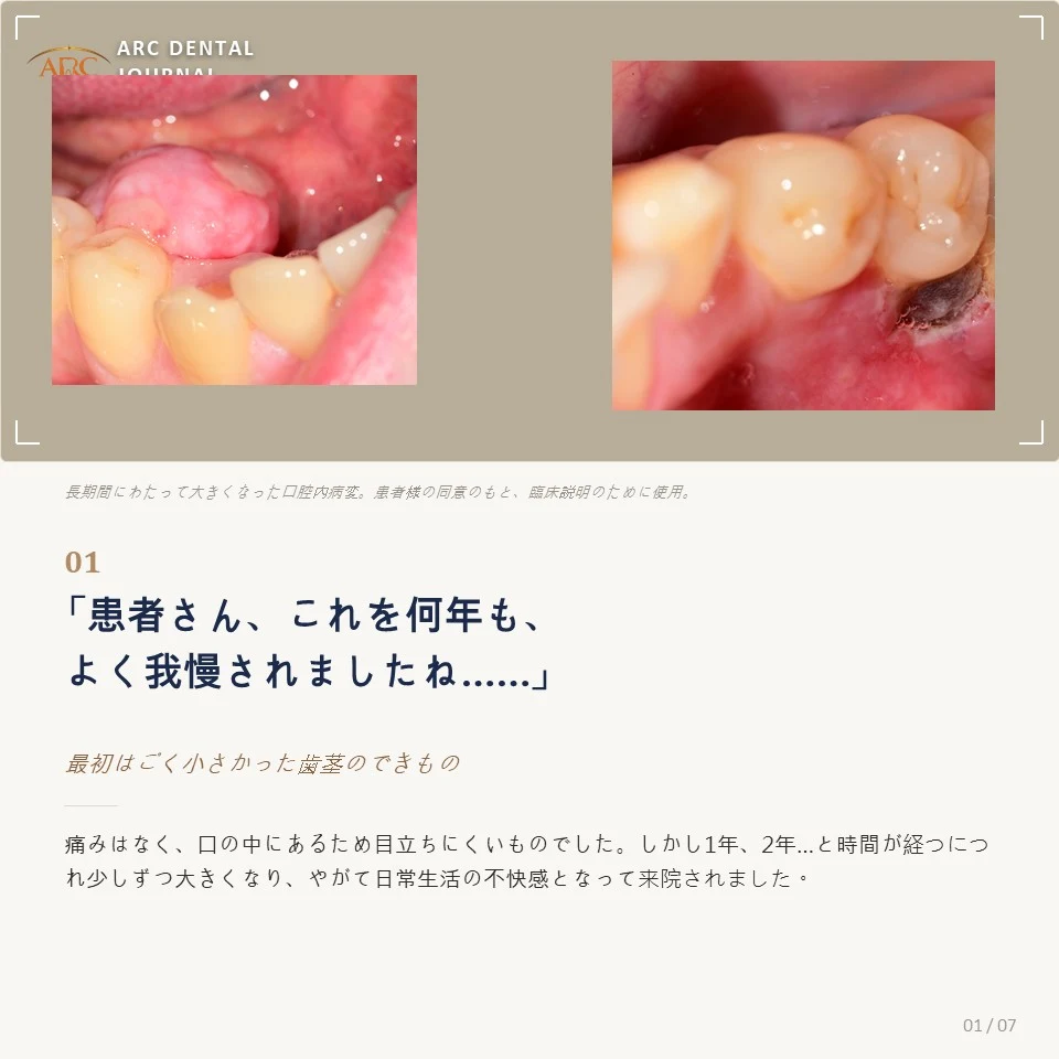 長期間放置され大きくなった口腔内病変