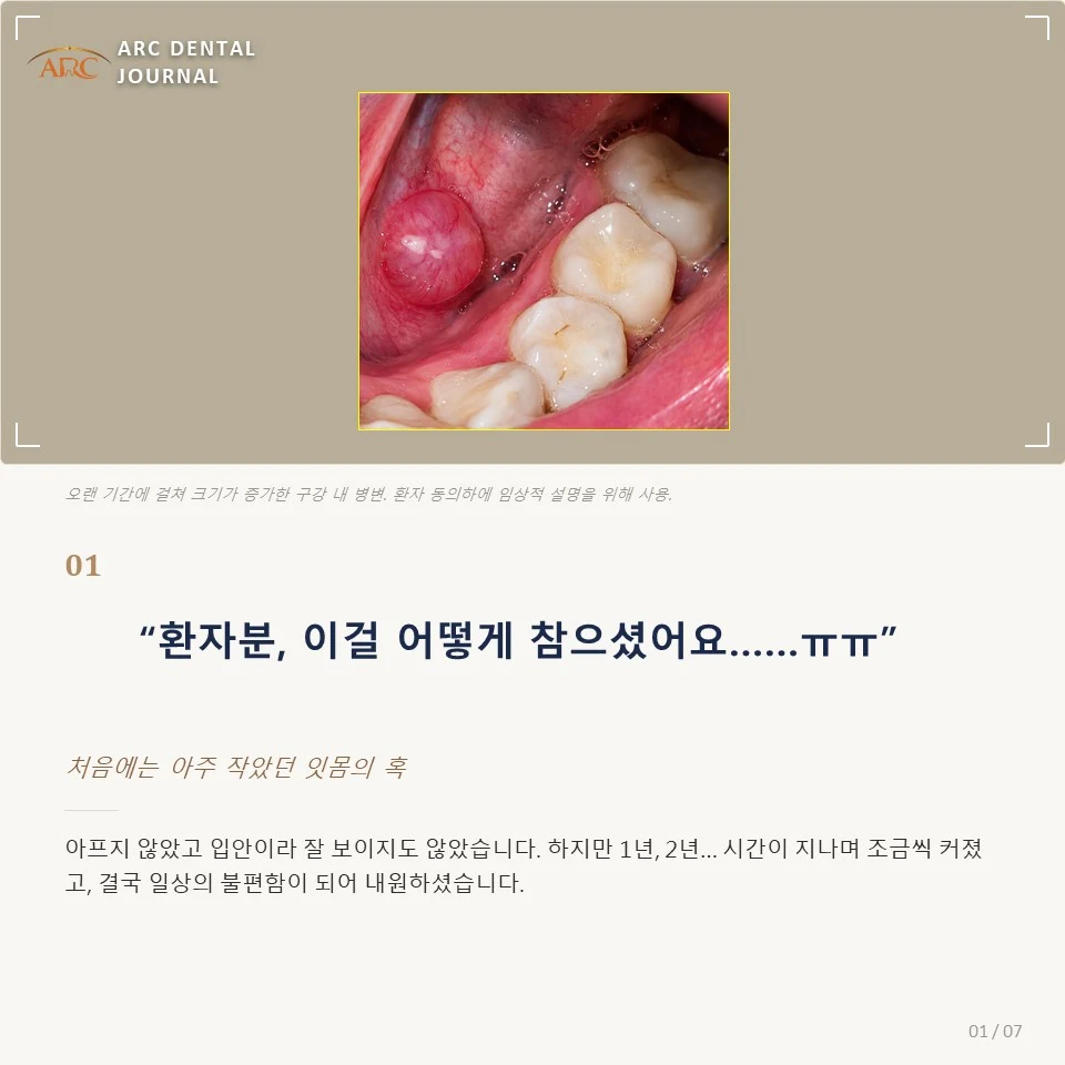 시간이 지나니까 점점 커지더라구요 — 처음에는 아주 작았던 잇몸의 혹