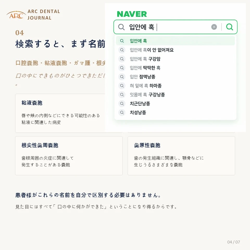 検索すると出てくる口腔嚢胞・粘液嚢胞・ガマ腫などの名前